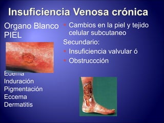Organo Blanco  PIEL Edema Induración Pigmentación Eccema Dermatitis Cambios en la piel y tejido celular subcutaneo Secundario: Insuficiencia valvular ó Obstruccción 