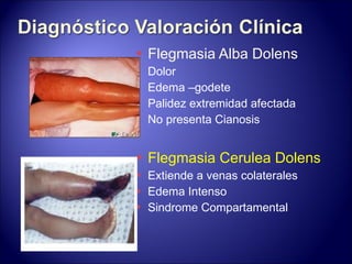Flegmasia Alba Dolens Dolor Edema –godete Palidez extremidad afectada No presenta Cianosis Flegmasia Cerulea Dolens Extiende a venas colaterales Edema Intenso Sindrome Compartamental 
