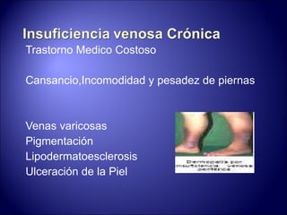 Trastorno Medico Costoso Cansancio,Incomodidad y pesadez de piernas Venas varicosas Pigmentación Lipodermatoesclerosis Ulceración de la Piel 