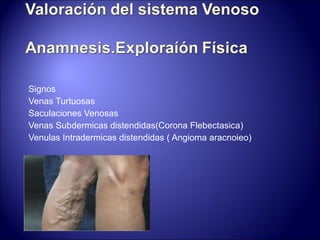 Signos Venas Turtuosas Saculaciones Venosas Venas Subdermicas distendidas(Corona Flebectasica) Venulas Intradermicas distendidas ( Angioma aracnoieo) 