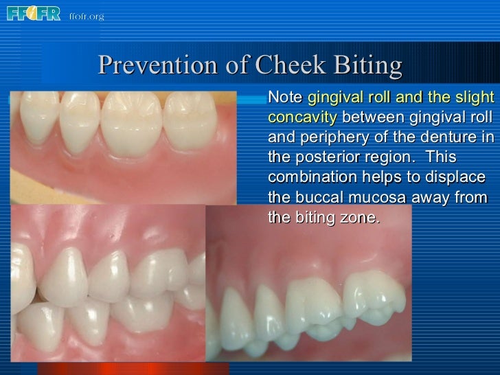 25.final wax contouring