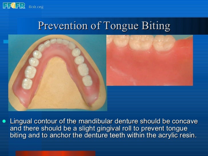 25.final wax contouring