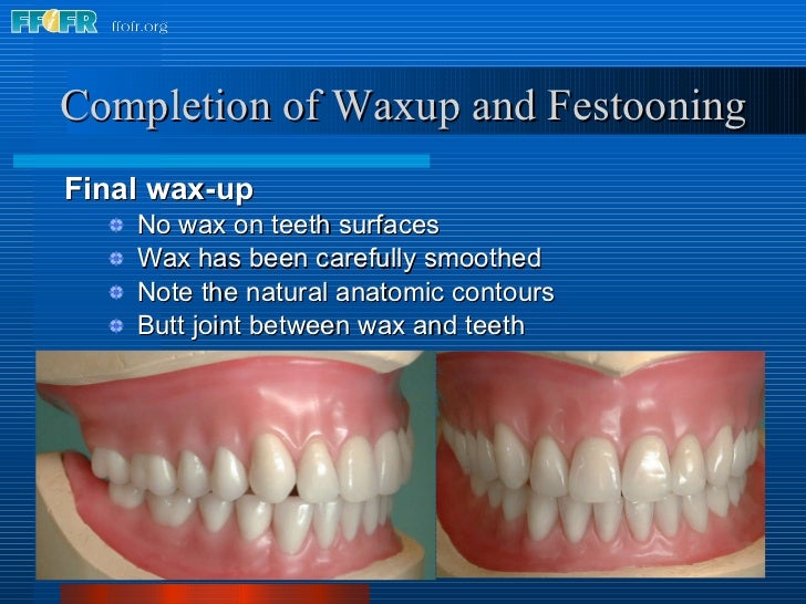 25.final wax contouring