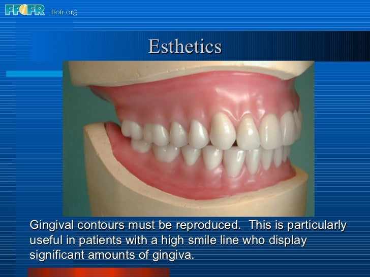 25.final wax contouring