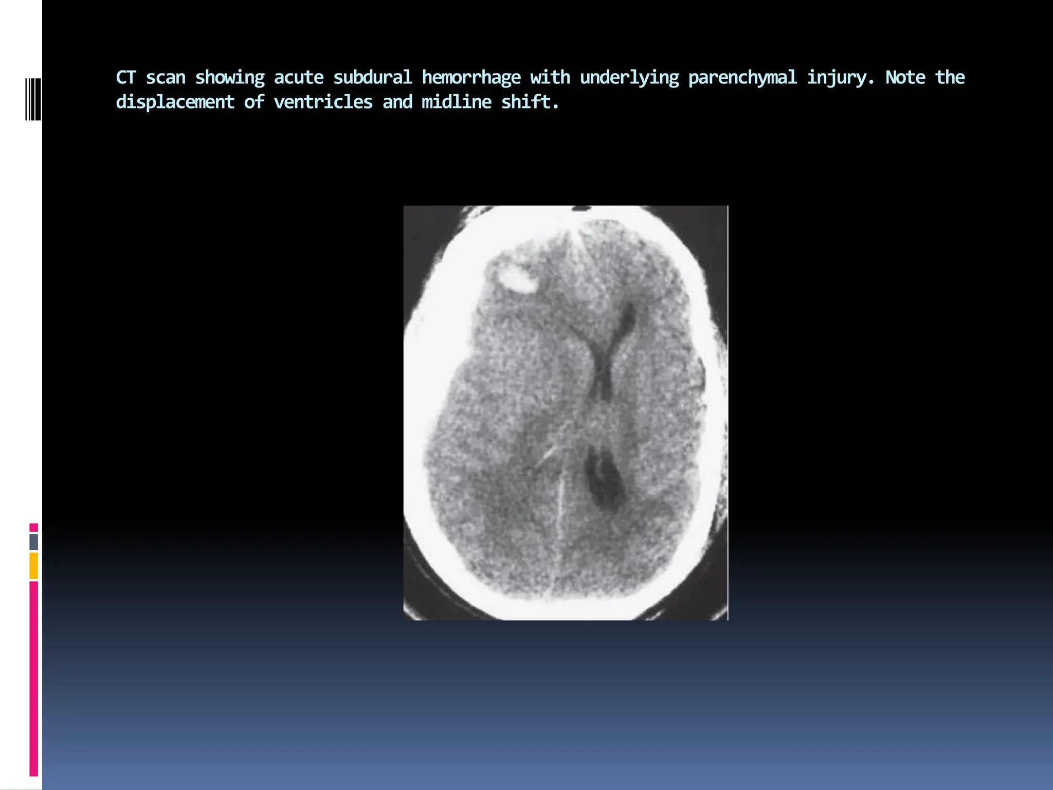 CT scan showing acute subdural hemorrhage with underlying parenchymal injury. Note the
displacement of ventricles and midline shift.
 