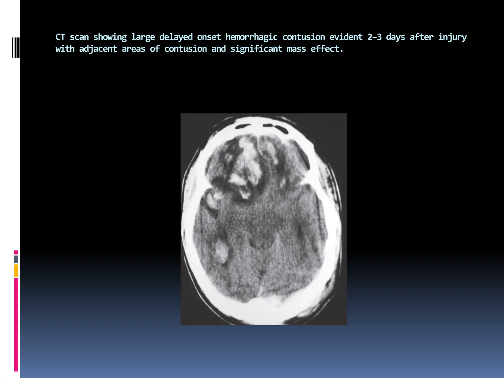 CT scan showing large delayed onset hemorrhagic contusion evident 2–3 days after injury
with adjacent areas of contusion and significant mass effect.
 
