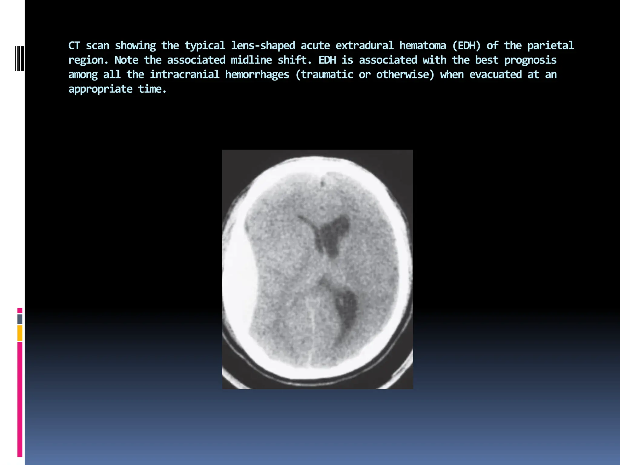 CT scan showing the typical lens-shaped acute extradural hematoma (EDH) of the parietal
region. Note the associated midline shift. EDH is associated with the best prognosis
among all the intracranial hemorrhages (traumatic or otherwise) when evacuated at an
appropriate time.
 