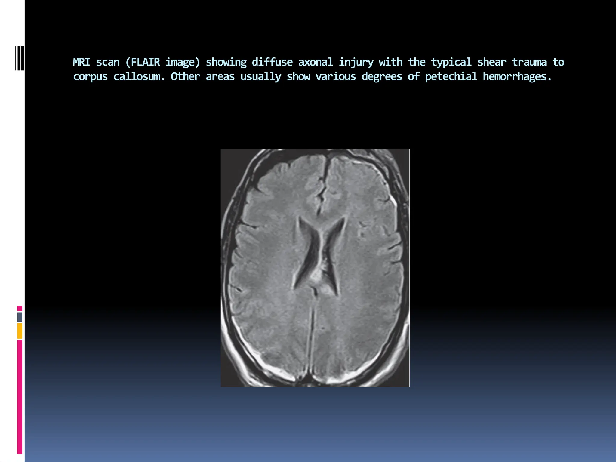 MRI scan (FLAIR image) showing diffuse axonal injury with the typical shear trauma to
corpus callosum. Other areas usually show various degrees of petechial hemorrhages.
 
