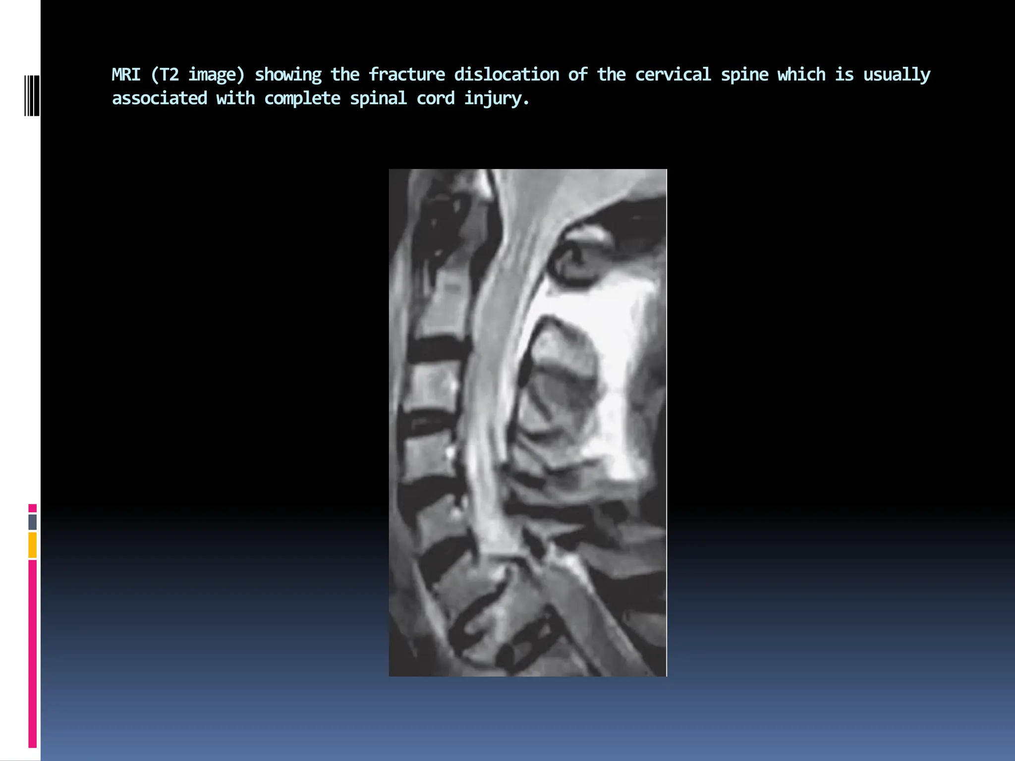 MRI (T2 image) showing the fracture dislocation of the cervical spine which is usually
associated with complete spinal cord injury.
 