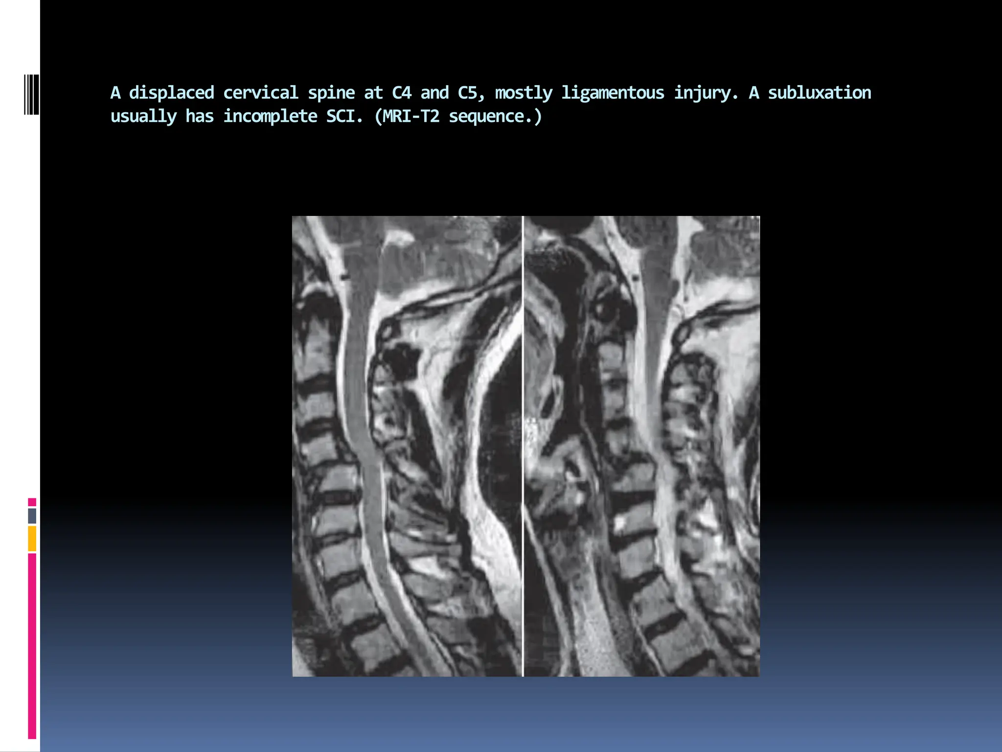 A displaced cervical spine at C4 and C5, mostly ligamentous injury. A subluxation
usually has incomplete SCI. (MRI-T2 sequence.)
 