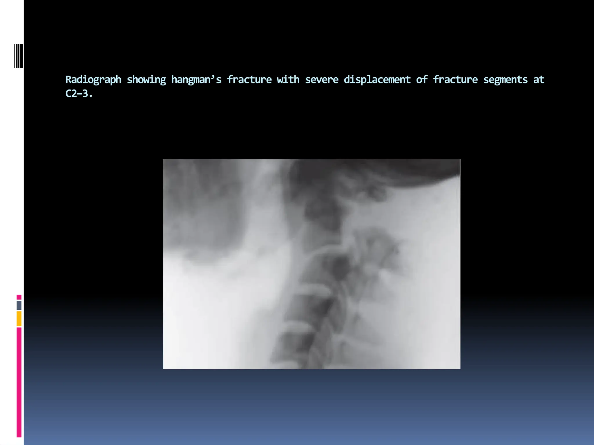 Radiograph showing hangman’s fracture with severe displacement of fracture segments at
C2–3.
 