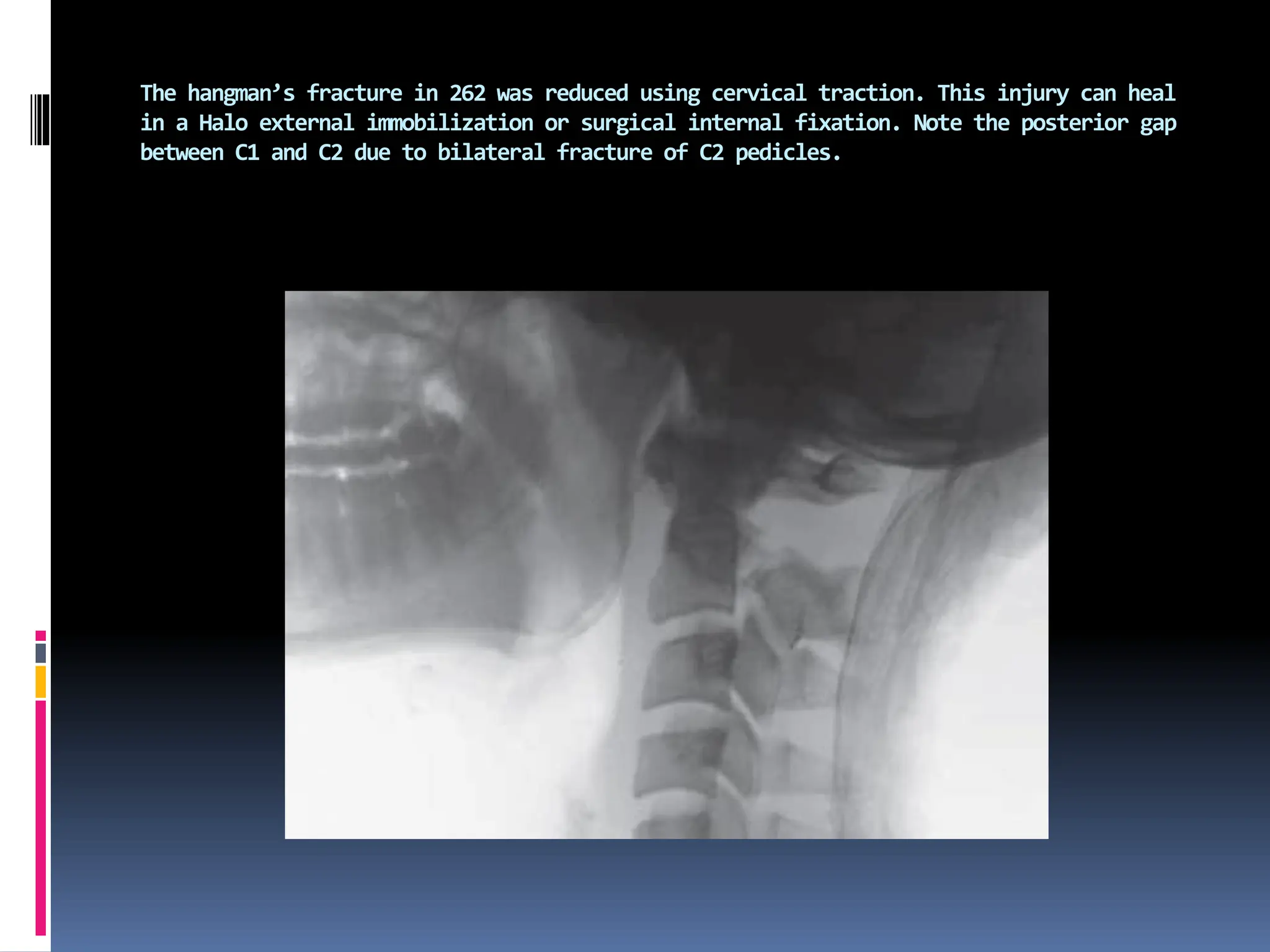 The hangman’s fracture in 262 was reduced using cervical traction. This injury can heal
in a Halo external immobilization or surgical internal fixation. Note the posterior gap
between C1 and C2 due to bilateral fracture of C2 pedicles.
 