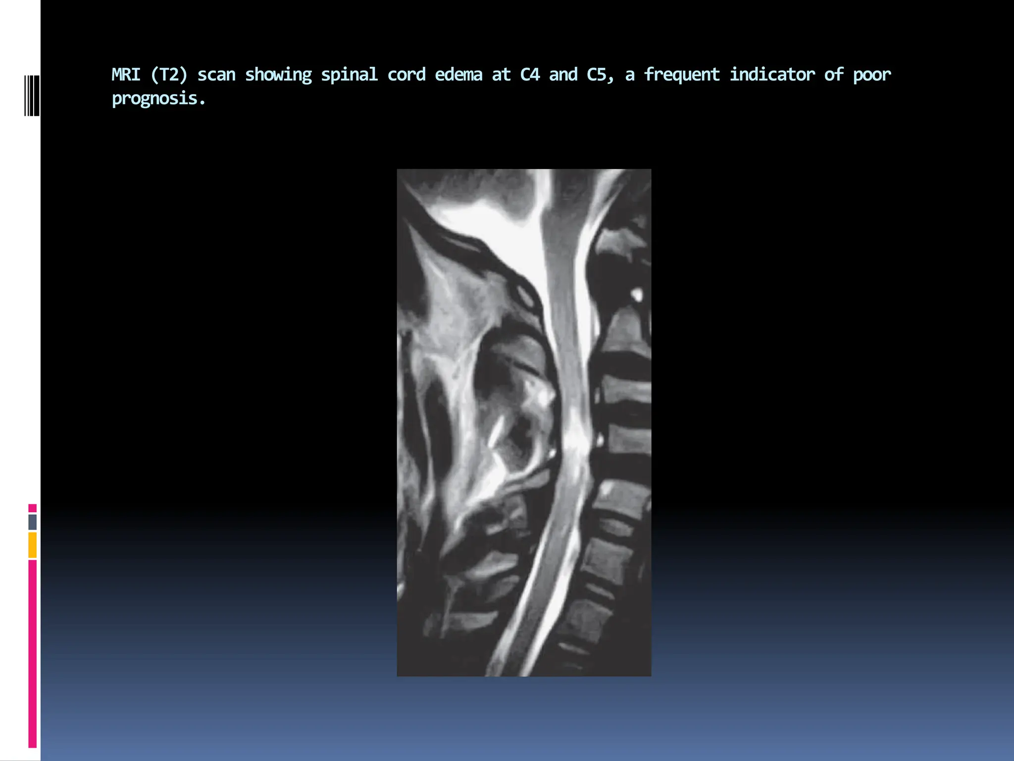 MRI (T2) scan showing spinal cord edema at C4 and C5, a frequent indicator of poor
prognosis.
 