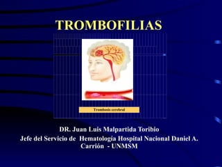 TROMBOFILIAS   DR. Juan Luis Malpartida Toribio Jefe del Servicio de  Hematología Hospital Nacional Daniel A. Carrión  - UNMSM 