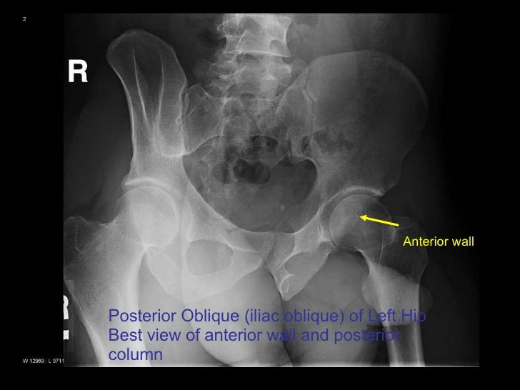 25 Year Old Status Post MVA