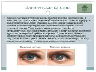 Клиническая картина
 Наиболее частым симптомом катаракты является снижение остроты зрения. В
зависимости от расположения ...