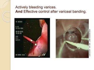 Actively bleeding varices.
And Effective control after variceal banding.
 