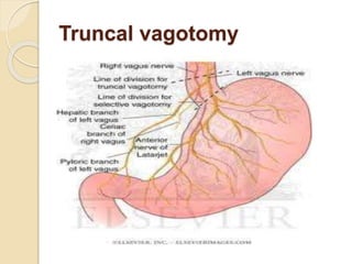 Truncal vagotomy
 