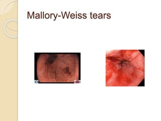 Mallory-Weiss tears
 