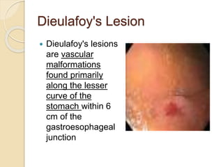 Dieulafoy's Lesion
 Dieulafoy's lesions
are vascular
malformations
found primarily
along the lesser
curve of the
stomach within 6
cm of the
gastroesophageal
junction
 