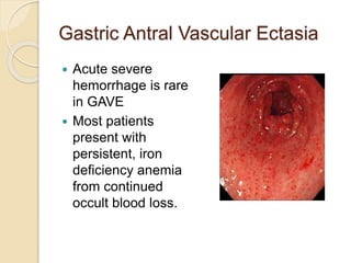 Gastric Antral Vascular Ectasia
 Acute severe
hemorrhage is rare
in GAVE
 Most patients
present with
persistent, iron
deficiency anemia
from continued
occult blood loss.
 