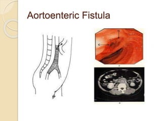 Aortoenteric Fistula
 