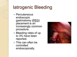 Iatrogenic Bleeding
 Percutaneous
endoscopic
gastrostomy (PEG)
placement is an
increasingly common
procedure.
 Bleeding rates of up
to 3% have been
reported.
 This can often be
controlled
endoscopically.
 