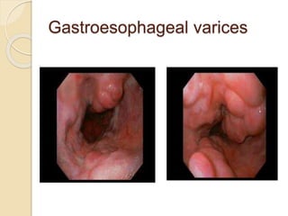 Gastroesophageal varices
 