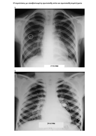 15 περιπτώσεις με επασβεστιωμένη πρωτοπαθή εστία και πρωτοπαθή συμπλέγματα
1.
2.
17/5/1980
29/4/1986
 