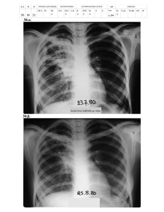 Α/Α Φ Η ΤΡΟΠΟΣ ΔΙΑΓΝΩΣΗΣ ΑΚΤΙΝΟΓΡΑΦΙΑ ΑΝΤΙΦΥΜΑΤΙΚΗ ΑΓΩΓΗ ΔΘ ΕΚΒΑΣΗ
30 Θ 21
ΠΕΛ ΤΕ ΝΣ
+
Π.Ε. Μ.Ε.
+
Λ.Ε. R
+
ΙΝΗ
+
Μ
+
Z S Νοσ.
Σπ.14
ΙΑ
+
Ιν.Στ. Υπ.Βλ ΕΠ Θ.
30.α.
30.β.
Δεξιά άνω λοβίτιδα με τήξη
 