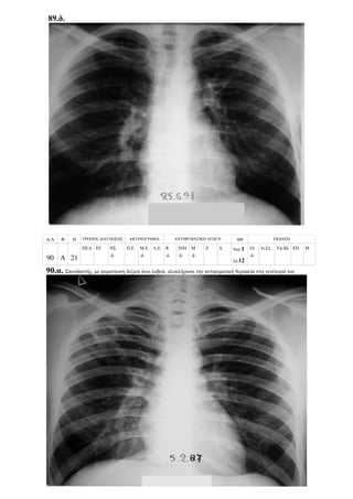 89.δ.
Α/Α Φ Η ΤΡΟΠΟΣ ΔΙΑΓΝΩΣΗΣ ΑΚΤΙΝΟΓΡΑΦΙΑ ΑΝΤΙΦΥΜΑΤΙΚΗ ΑΓΩΓΗ ΔΘ ΕΚΒΑΣΗ
90 Α 21
ΠΕΛ ΤΕ ΝΣ
+
Π.Ε. Μ.Ε.
+
Λ.Ε. R
+
ΙΝΗ
+
Μ
+
Z S Νοσ.1
Σπ.12
ΙΑ
+
Ιν.Στ. Υπ.Βλ ΕΠ Θ.
90.α. Σπουδαστής, με φυματίωση δεξιού άνω λοβού, ολοκλήρωσε την αντιφυματική θεραπεία στη γενέτειρά του
 