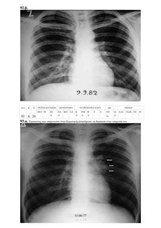 92.β.
Α/Α Φ Η ΤΡΟΠΟΣ ΔΙΑΓΝΩΣΗΣ ΑΚΤΙΝΟΓΡΑΦΙΑ ΑΝΤΙΦΥΜΑΤΙΚΗ ΑΓΩΓΗ ΔΘ ΕΚΒΑΣΗ
93 Α 20
ΠΕΛ ΤΕ ΝΣ
+
Π.Ε.
+
Μ.Ε. Λ.Ε. R
+
ΙΝΗ
+
Μ
+
Z S Νοσ.
Σπ.
ΙΑ
+
Ιν.Στ. Υπ.Βλ ΕΠ Θ.
93.α. Στρατιώτης που υπηρετούσε στην Κομοτηνή,ολοκλήρωσε τη θεραπεία στην υπηρεσία του
11-06-77
 
