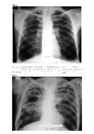 111.γ.
Α/Α Φ Η ΤΡΟΠΟΣ ΔΙΑΓΝΩΣΗΣ ΑΚΤΙΝΟΓΡΑΦΙΑ ΑΝΤΙΦΥΜΑΤΙΚΗ ΑΓΩΓΗ ΔΘ ΕΚΒΑΣΗ
112 Α 68
ΠΕΛ ΤΕ ΝΣ
+
Π.Ε. Μ.Ε. Λ.Ε.
+
R
+
ΙΝΗ
+
Μ
+
Z S
+
Νοσ.4
Σπ.10
ΙΑ
+
Ιν.Στ. Υπ.Βλ
+
ΕΠ Θ.
112.α.
 