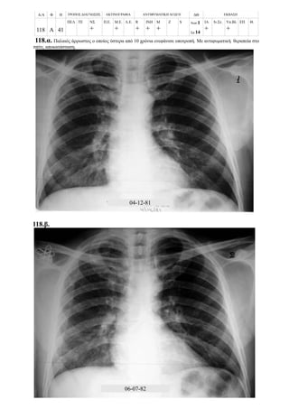 Α/Α Φ Η ΤΡΟΠΟΣ ΔΙΑΓΝΩΣΗΣ ΑΚΤΙΝΟΓΡΑΦΙΑ ΑΝΤΙΦΥΜΑΤΙΚΗ ΑΓΩΓΗ ΔΘ ΕΚΒΑΣΗ
118 Α 41
ΠΕΛ ΤΕ ΝΣ
+
Π.Ε. Μ.Ε.
+
Λ.Ε. R
+
ΙΝΗ
+
Μ
+
Z S Νοσ.1
Σπ.14
ΙΑ
+
Ιν.Στ. Υπ.Βλ
+
ΕΠ Θ.
118.α. Παλαιός άρρωστος ο οποίος ύστερα από 10 χρόνια ενεφάνισε υποτροπή. Με αντιφυματική θεραπεία στο
σπίτι, αποκατάσταση.
118.β.
04-12-81
06-07-82
 