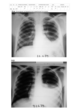 Α/Α Φ Η ΤΡΟΠΟΣ ΔΙΑΓΝΩΣΗΣ ΑΚΤΙΝΟΓΡΑΦΙΑ ΑΝΤΙΦΥΜΑΤΙΚΗ ΑΓΩΓΗ ΔΘ ΕΚΒΑΣΗ
16 Α 17
ΠΕΛ ΤΕ ΝΣ
+
+ ++ +++
+
R
+
ΙΝΗ
+
Μ
+
Z S Νοσ.
Σπ.
ΙΑ
+
Ιν.Στ. Υπ.Βλ ΕΠ Θ.
16.α. Ολοκλήρωσε τη θεραπεία στον ασφαλιστικό του φορέα.
16.β.
 