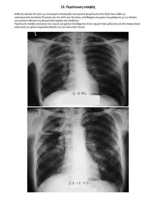 12. Περίπτωση επαφής
Ασθενής ηλικίας 42 ετών, με εκτεταμένη σπηλαιώδη πνευμονική φυματίωση στον δεξιό άνω λοβό, με
νοσοκομειακή νοσηλεία 20 μηνών και στο σπίτι για 18 μήνες, απείθαρχος και χωρίς συμμόρφωση με τις οδηγίες
των γιατρών έφτασε στη φυματιώδη καχεξία και απεβίωσε.
Περίπτωση επαφής (σύζυγος) που έμεινε για χρόνια (τουλάχιστον 6) σε ισχυρή πηγή μόλυνσης και δεν παρουσίασε
νόσο κατά τον χρόνο παρακολούθησής της την τελευταία 25ετία
 