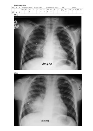 Περίπτωση 15η:
Α/Α Φ Η ΤΡΟΠΟΣ ΔΙΑΓΝΩΣΗΣ ΑΚΤΙΝΟΓΡΑΦΙΑ ΑΝΤΙΦΥΜΑΤΙΚΗ ΑΓΩΓΗ ΔΘ ΕΚΒΑΣΗ
15 Α 6
ΠΕΛ ΤΕ ΝΣ
+
+ ++ +++
+
R
+
ΙΝΗ
+
Μ
+
Z S Νοσ.
Σπ.12
ΙΑ
+
Ιν.Στ. Υπ.Βλ ΕΠ Θ.
15.α.
15.β.
28/5/1992
 
