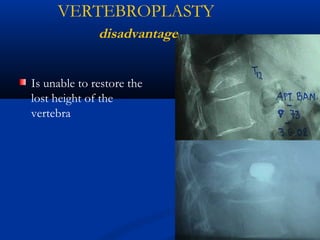 Is unable to restore the
lost height of the
vertebra
VERTEBROPLASTY
disadvantage
 
