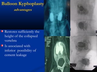 Balloon Kyphoplasty
advantages
Restores sufficiently the
height of the collapsed
vertebra
Is associated with
inferior possibility of
cement leakage
 