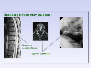 Προβολές δίσκου στον Θώρακα :Προβολές δίσκου στον Θώρακα :
΄Εγχυση DISCOGEL®
Θωρακική
προβολή δίσκου
 