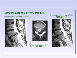 Προβολές δίσκου στην Οσφυική:Προβολές δίσκου στην Οσφυική:
΄Εγχυση DISCOGEL®
Προ εφαρμογής του DISCOGEL®
6 μήνες μετά την εφαρμογή του
DISCOGEL®
 