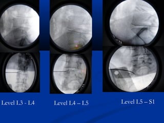 Level L3 - L4 Level L4 – L5 Level L5 – S1
 