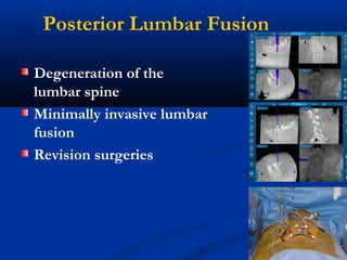 Posterior Lumbar Fusion
Degeneration of the
lumbar spine
Minimally invasive lumbar
fusion
Revision surgeries
 