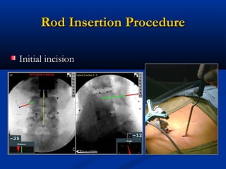 Rod Insertion ProcedureRod Insertion Procedure
Initial incisionInitial incision
 