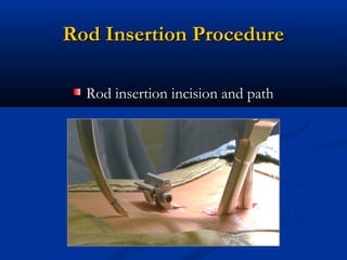 Rod Insertion ProcedureRod Insertion Procedure
Rod insertion incision and pathRod insertion incision and path
 