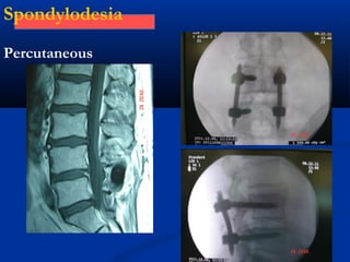 Spondylodesia
Percutaneous
 
