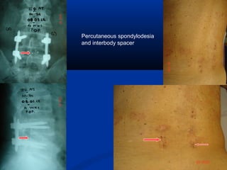 Percutaneous spondylodesia
and interbody spacer
 