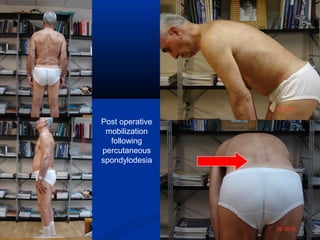 Post operative
mobilization
following
percutaneous
spondylodesia
 