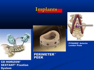 ImplantsImplants
PYRAMID®
Anterior
Lumbar Plate
PERIMETER™
PEEK
CD HORIZON®
SEXTANT®
Fixation
System
 