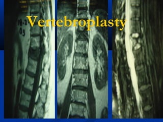 Vertebroplasty
 
